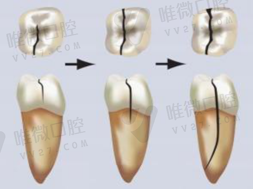 假牙的清洁和护理的区别,假牙清洁片有必要吗(图1)
